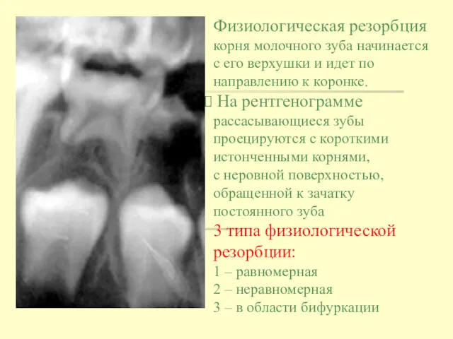 Физиологическая резорбция корня молочного зуба начинается с его верхушки и