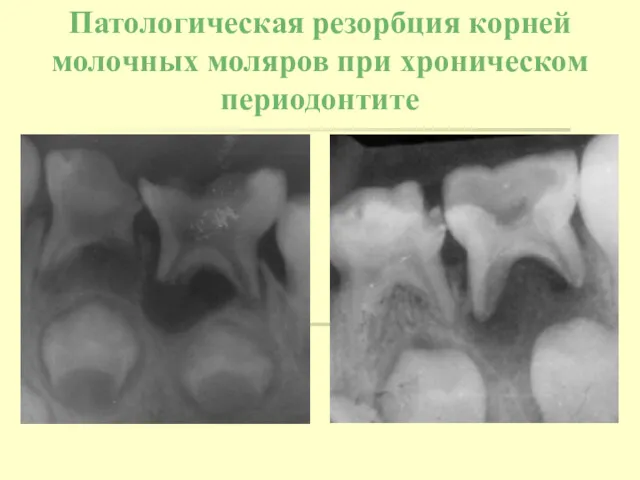 Патологическая резорбция корней молочных моляров при хроническом периодонтите