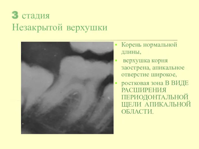 3 стадия Незакрытой верхушки Корень нормальной длины, верхушка корня заострена,