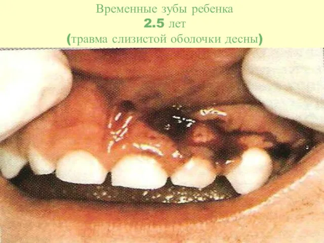 Временные зубы ребенка 2.5 лет (травма слизистой оболочки десны)
