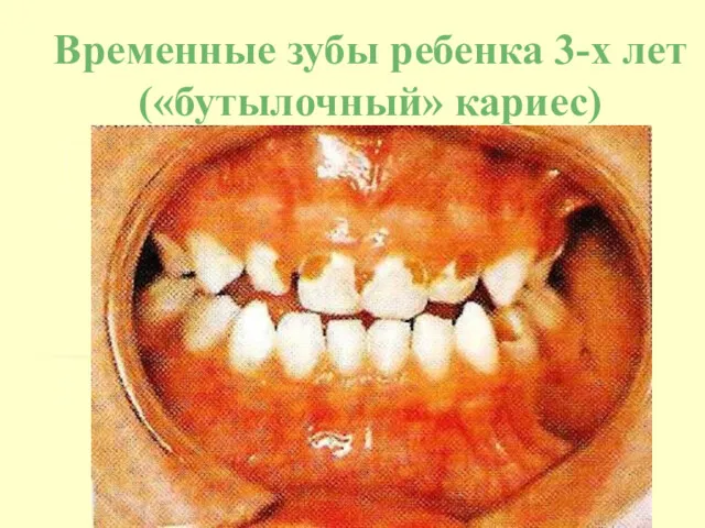 Временные зубы ребенка 3-х лет («бутылочный» кариес)
