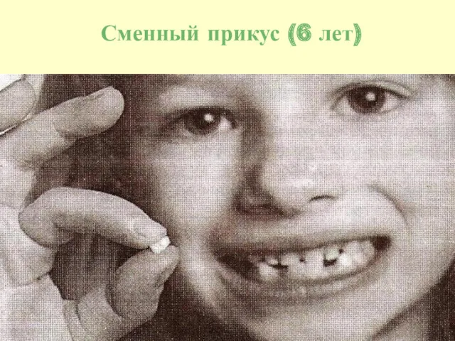 Сменный прикус (6 лет)