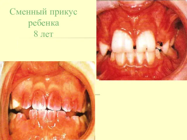 Сменный прикус ребенка 8 лет