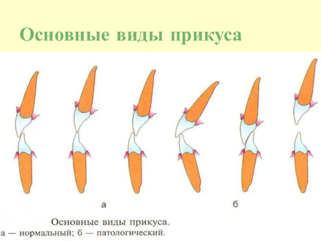 Основные виды прикуса