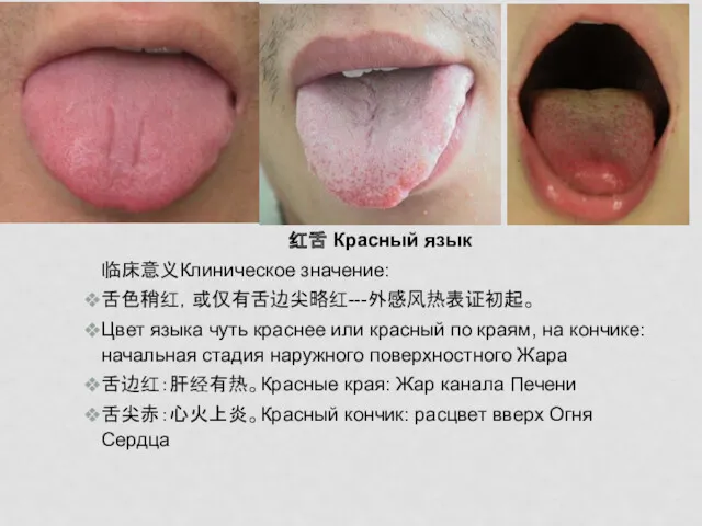 红舌 Красный язык 临床意义Клиническое значение: 舌色稍红，或仅有舌边尖略红---外感风热表证初起。 Цвет языка чуть краснее или красный по