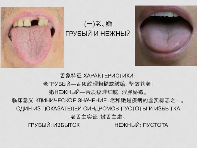 (一)老、嫩 ГРУБЫЙ И НЕЖНЫЙ 舌象特征 ХАРАКТЕРИСТИКИ： 老ГРУБЫЙ—舌质纹理粗糙或皱缩，坚敛苍老； 嫩НЕЖНЫЙ—舌质纹理细腻，浮胖娇嫩。 临床意义 КЛИНИЧЕСКОЕ ЗНАЧЕНИЕ：老和嫩是疾病的虚实标志之一。 ОДИН ИЗ
