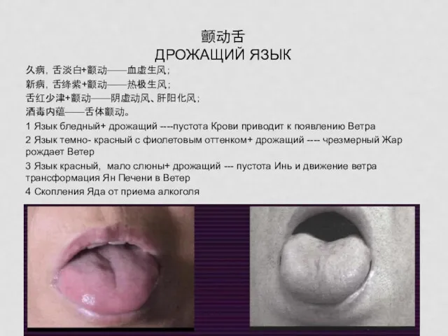 颤动舌 ДРОЖАЩИЙ ЯЗЫК 久病，舌淡白+颤动——血虚生风； 新病，舌绛紫+颤动——热极生风； 舌红少津+颤动——阴虚动风、肝阳化风； 酒毒内蕴——舌体颤动。 1 Язык бледный+ дрожащий ----пустота Крови