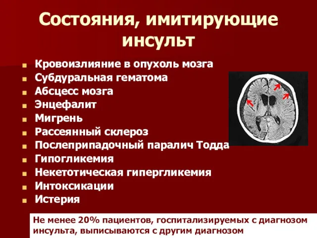 Состояния, имитирующие инсульт Кровоизлияние в опухоль мозга Субдуральная гематома Абсцесс