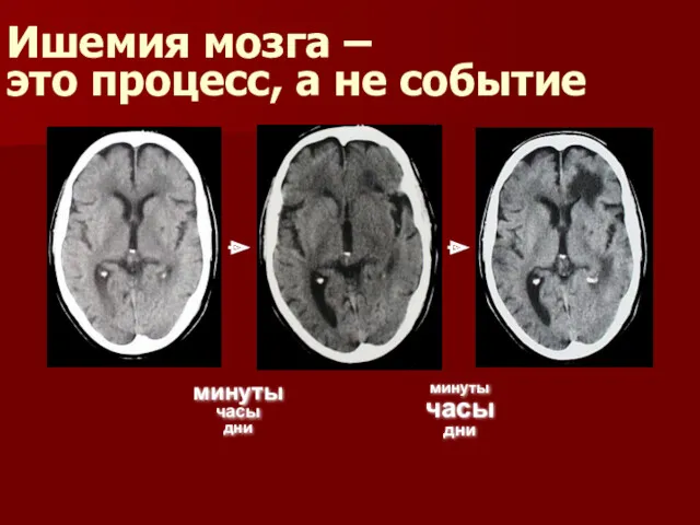 Ишемия мозга – это процесс, а не событие минуты часы дни минуты часы дни