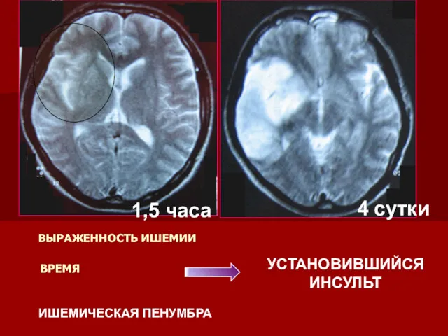 1,5 часа 4 сутки ВЫРАЖЕННОСТЬ ИШЕМИИ ВРЕМЯ ИШЕМИЧЕСКАЯ ПЕНУМБРА УСТАНОВИВШИЙСЯ ИНСУЛЬТ