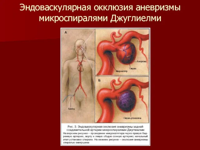 Эндоваскулярная окклюзия аневризмы микроспиралями Джуглиелми