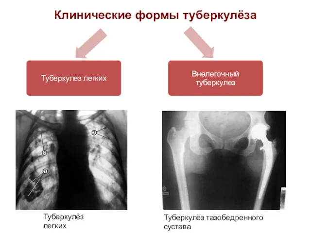 Клинические формы туберкулёза Туберкулёз тазобедренного сустава Туберкулёз легких