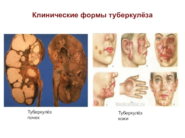 Клинические формы туберкулёза Туберкулёз почек Туберкулёз кожи