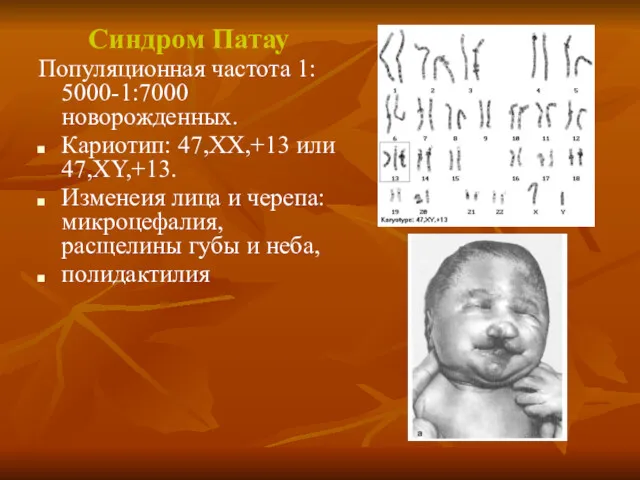 Синдром Патау Популяционная частота 1: 5000-1:7000 новорожденных. Кариотип: 47,ХХ,+13 или