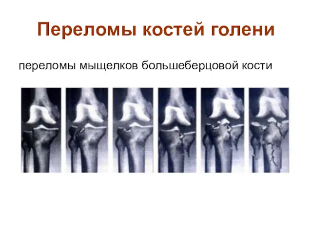 Переломы костей голени переломы мыщелков большеберцовой кости