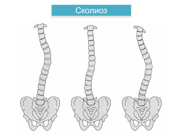 Сколиоз