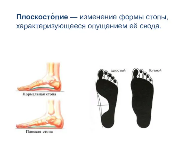 Плоскосто́пие — изменение формы стопы, характеризующееся опущением её свода.