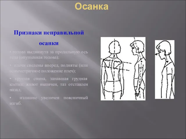 Осанка Признаки неправильной осанки • голова выдвинута за продольную ось