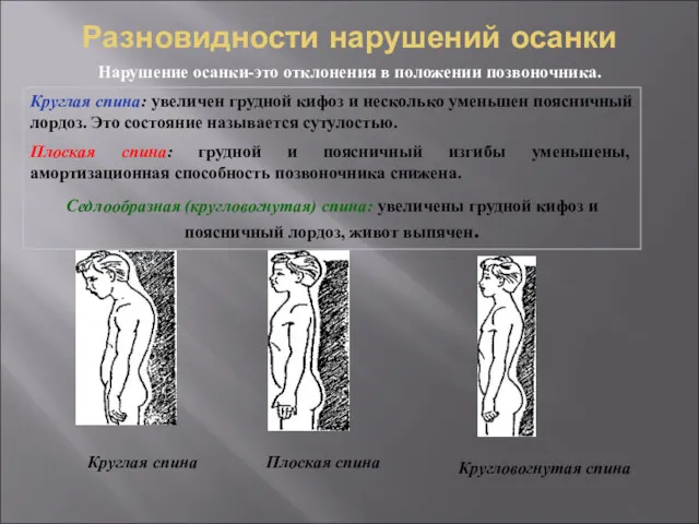 Разновидности нарушений осанки Нарушение осанки-это отклонения в положении позвоночника. Круглая