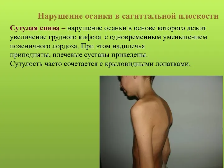 Сутулая спина – нарушение осанки в основе которого лежит увеличение грудного кифоза с