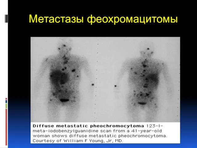 Метастазы феохромацитомы