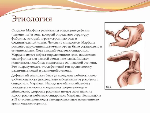 Этиология Синдром Марфана развивается вследствие дефекта (изменения) в гене, который