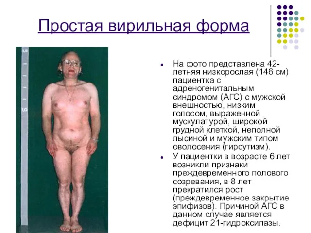 Простая вирильная форма На фото представлена 42-летняя низкорослая (146 см) пациентка с адреногенитальным