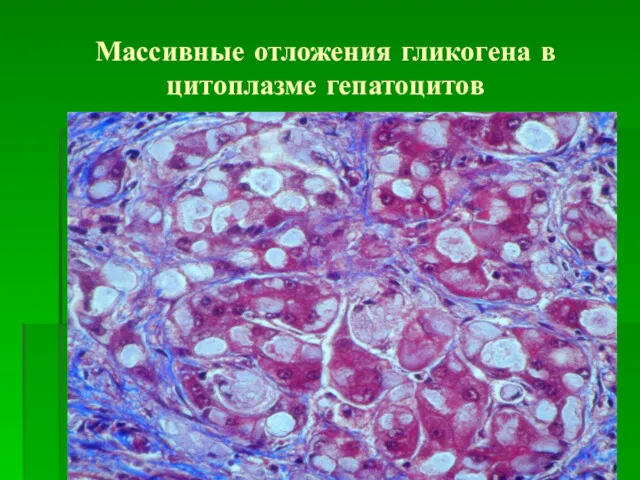 Массивные отложения гликогена в цитоплазме гепатоцитов