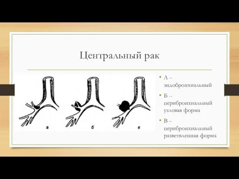 Центральный рак А – эндобронхиальный Б – перибронхиальный узловая форма В – перибронхиальный разветвленная форма