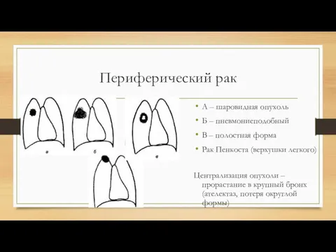 Периферический рак А – шаровидная опухоль Б – пневмониеподобный В