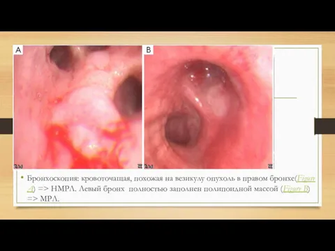 Бронхоскопия: кровоточащая, похожая на везикулу опухоль в правом бронхе(Figure A)