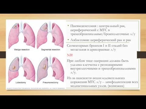 Пневмонэктомия : центральный рак, периферический с МТС в трахеобронхиальные/бронхолегочные л/у