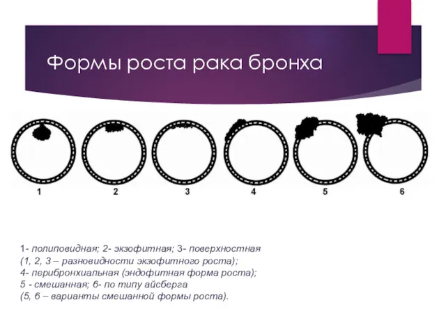 Формы роста рака бронха 1- полиповидная; 2- экзофитная; 3- поверхностная (1, 2, 3