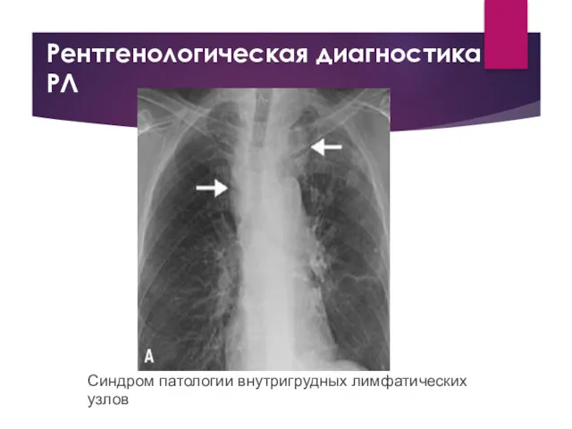 Рентгенологическая диагностика РЛ Синдром патологии внутригрудных лимфатических узлов