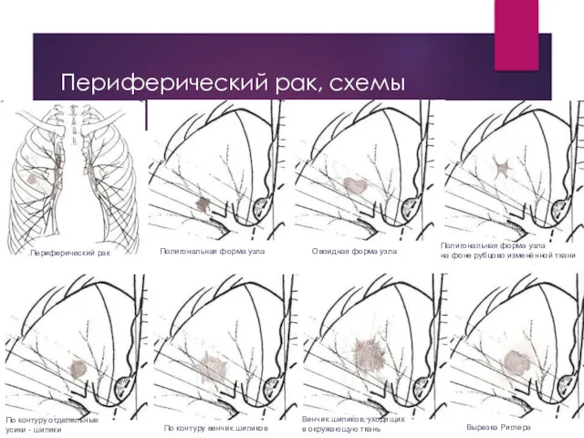 Периферический рак, схемы .Периферический рак Полигональная форма узла Овоидная форма узла Полигональная форма