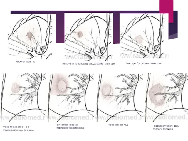 Корона малигна Тень узла неоднородная, дорожка к плевре Контуры бугристые, нечеткие Фаза множественного