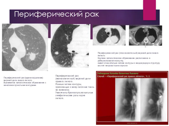 Периферический рак Периферический рак (аденокарцинома) верхней доли левого легкого. Выявляется патологическое образование с