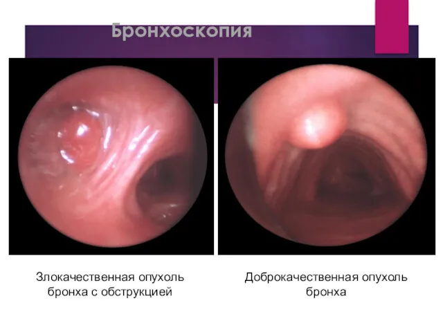 Бронхоскопия Злокачественная опухоль бронха с обструкцией Доброкачественная опухоль бронха