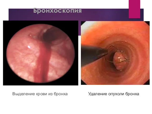 Бронхоскопия Выделение крови из бронха Удаление опухоли бронха