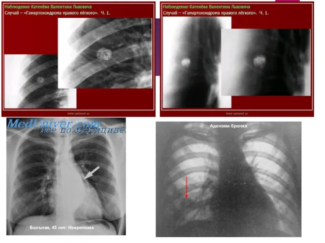 Больная, 45 лет: Невринома Аденома бронха