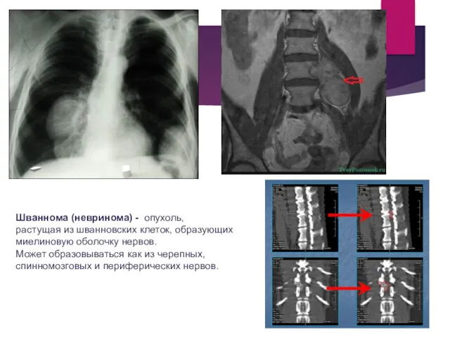 Шваннома (невринома) - опухоль, растущая из шванновских клеток, образующих миелиновую оболочку нервов. Может