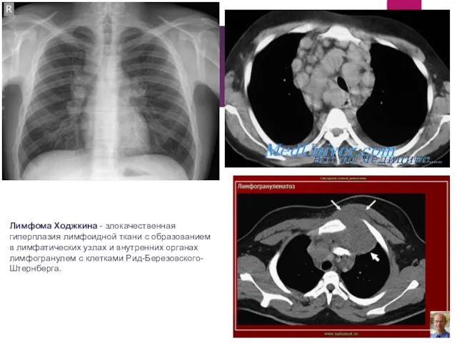 Лимфома Ходжкина - злокачественная гиперплазия лимфоидной ткани с образованием в