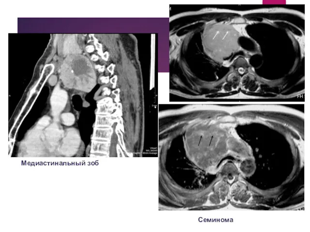 Медиастинальный зоб Семинома