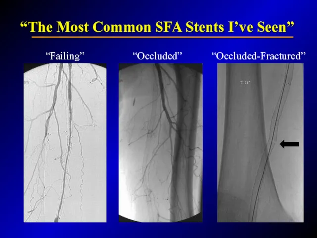 “The Most Common SFA Stents I’ve Seen” “Occluded” “Failing” “Occluded-Fractured”