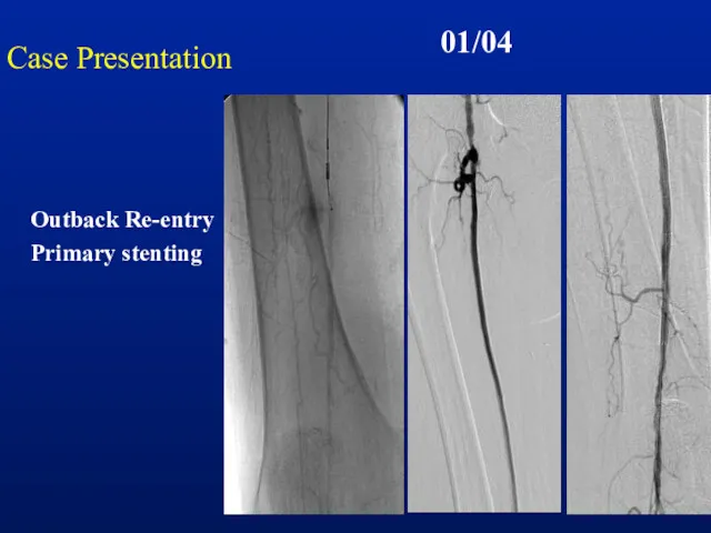Case Presentation 01/04 Outback Re-entry Primary stenting
