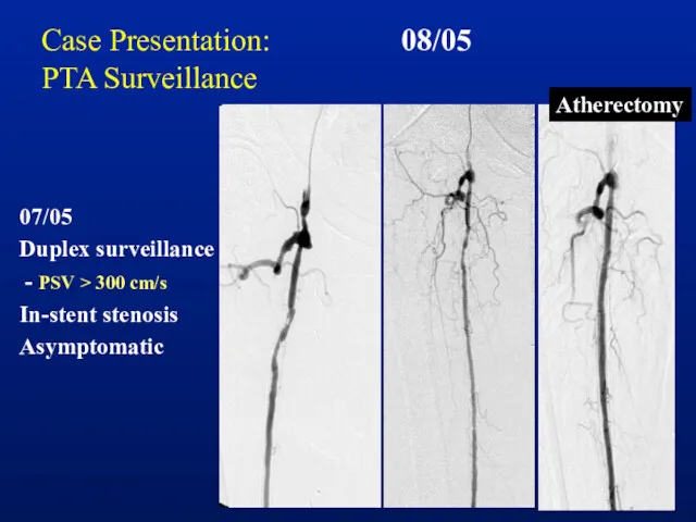 Case Presentation: PTA Surveillance 08/05 Atherectomy 07/05 Duplex surveillance - PSV > 300