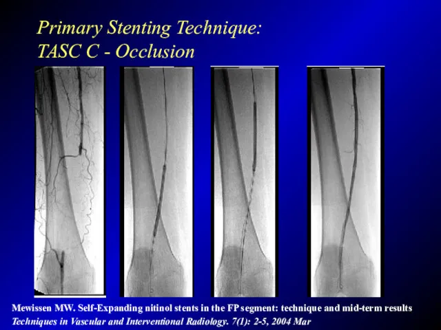 Primary Stenting Technique: TASC C - Occlusion Mewissen MW. Self-Expanding nitinol stents in