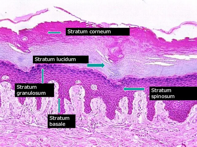 Stratum corneum Stratum lucidum Stratum spinosum Stratum granulosum Stratum basale