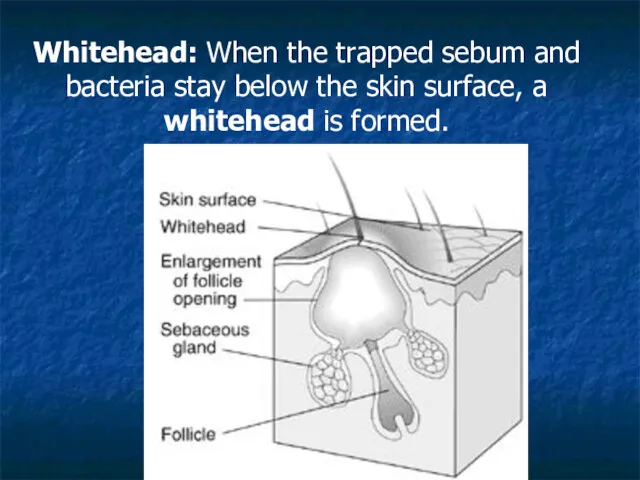 Whitehead: When the trapped sebum and bacteria stay below the skin surface, a whitehead is formed.