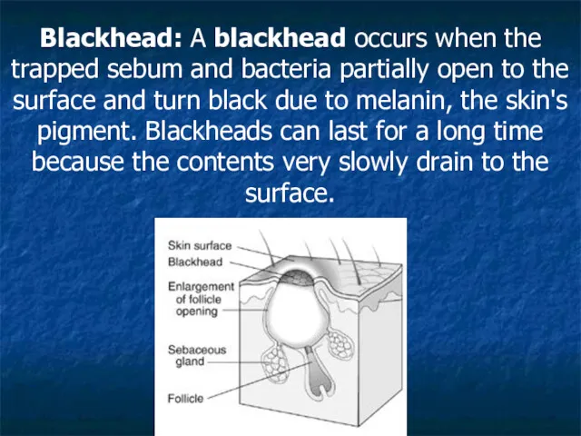 Blackhead: A blackhead occurs when the trapped sebum and bacteria partially open to